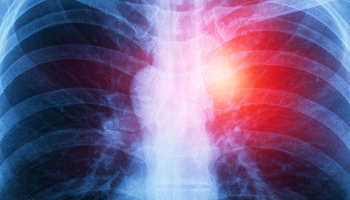 An X-ray image highlighting the chest are